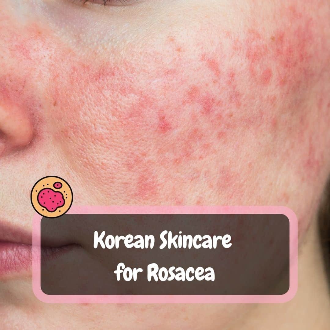 Korean Skincare For Rosacea The Holy Grail Of 2024 TheKoreanGuide